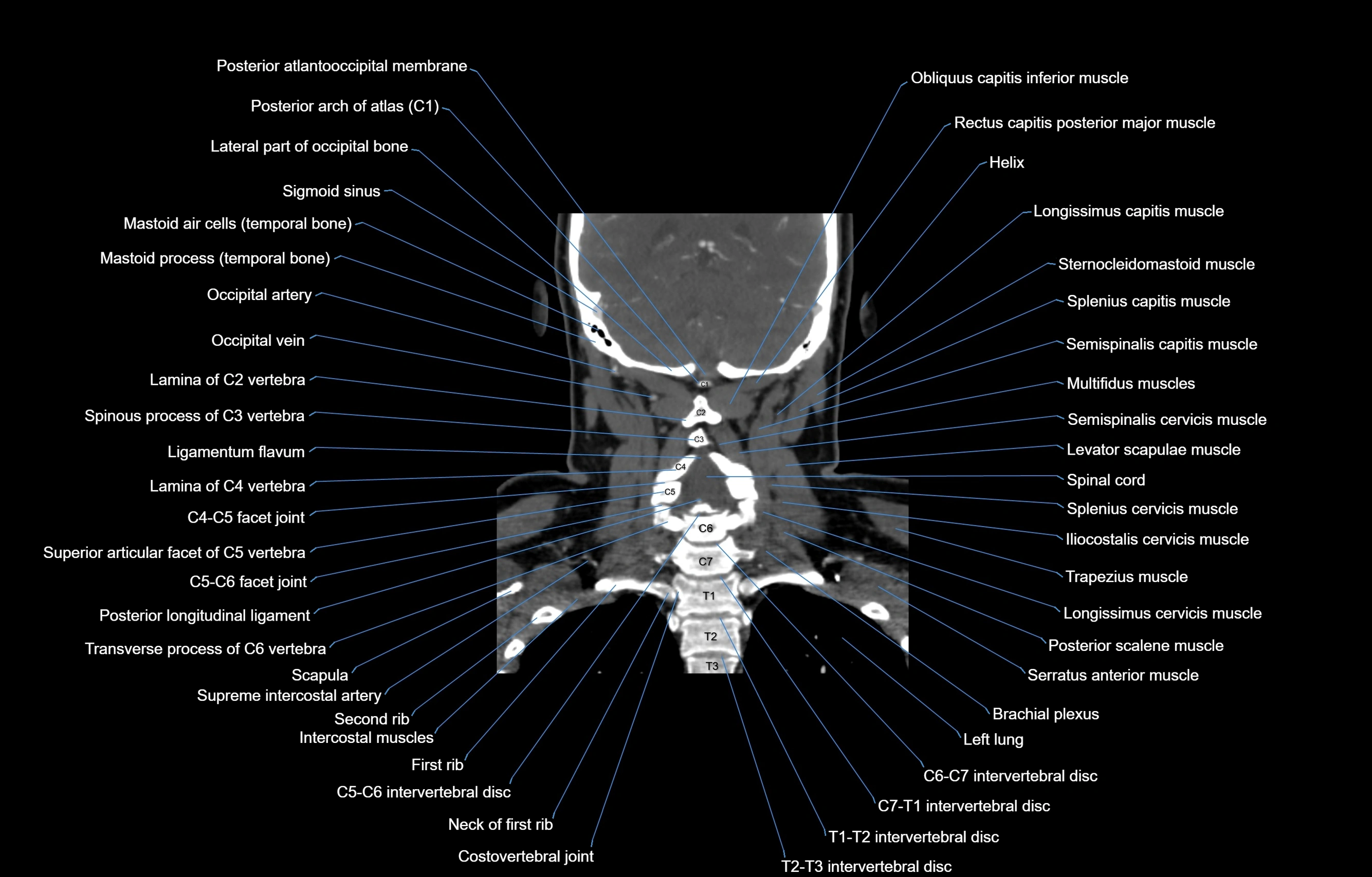CT Neck coronal  cross sectional anatomy labelled 3D  radiology  image-00048.webp